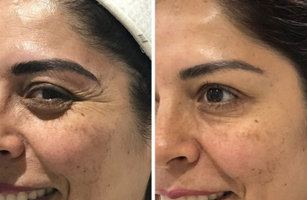 Anti-aging in Bangalore