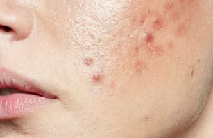 Acne Treatments in Bangalore