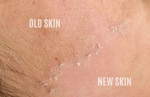 Chemical Peel in Bangalore