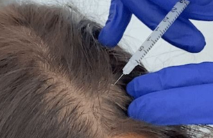 Hair Growth Boosters in Bangalore